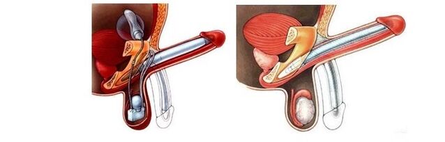 prosthetic penis enlargement