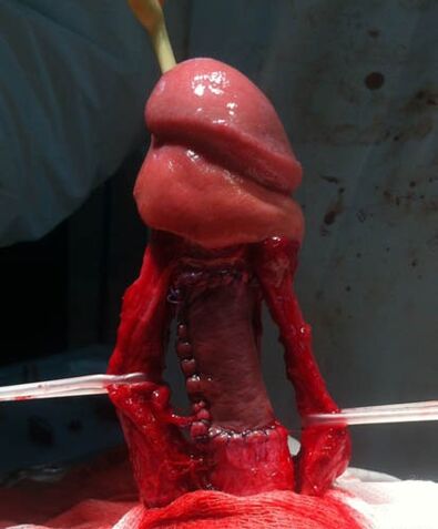 Surgical penis enlargement